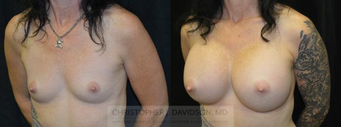 Breast Augmentation Case 31 Before & After View #2 | Boston, MA | Christopher J. Davidson, MD