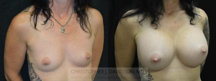 Breast Augmentation Case 31 Before & After View #3 | Boston, MA | Christopher J. Davidson, MD