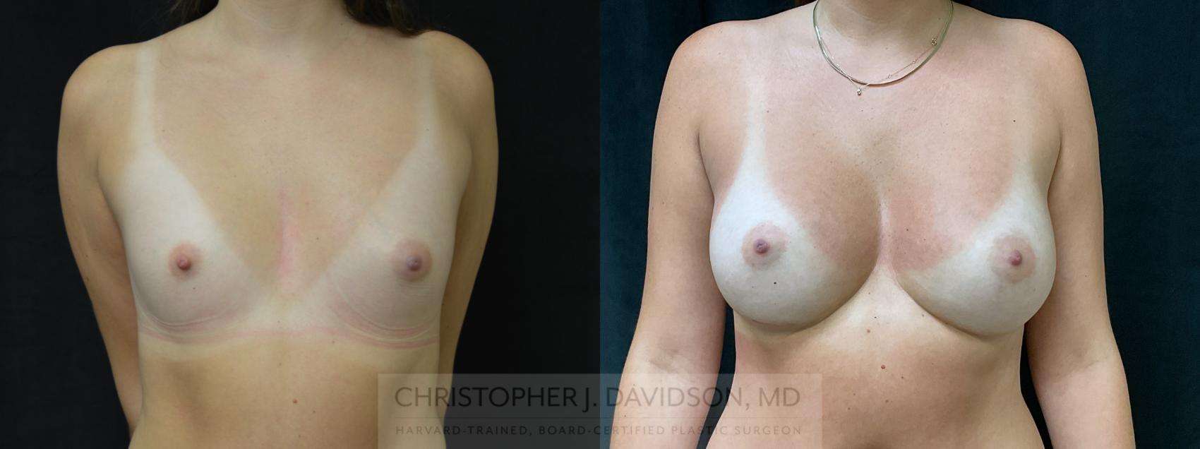 Breast Augmentation Case 326 Before & After Front | Boston, MA | Christopher J. Davidson, MD