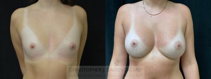 Breast Augmentation Case 326 Before & After Front | Boston, MA | Christopher J. Davidson, MD