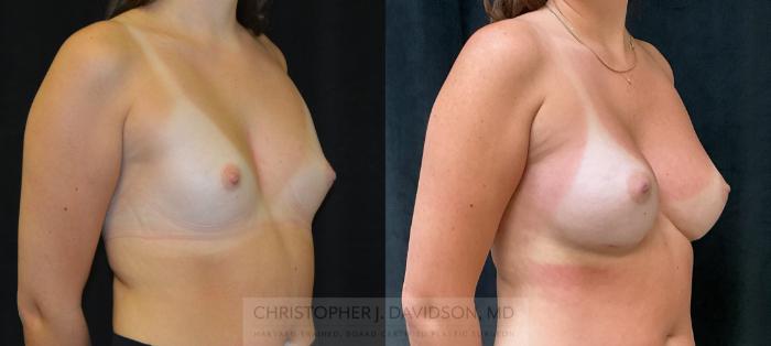 Breast Augmentation Case 326 Before & After Right Oblique | Boston, MA | Christopher J. Davidson, MD