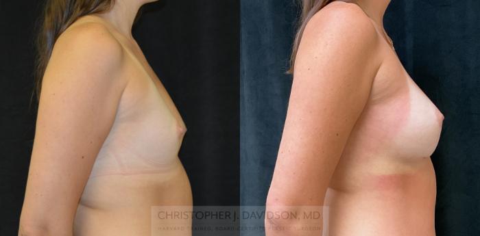 Breast Augmentation Case 326 Before & After Right Side | Boston, MA | Christopher J. Davidson, MD