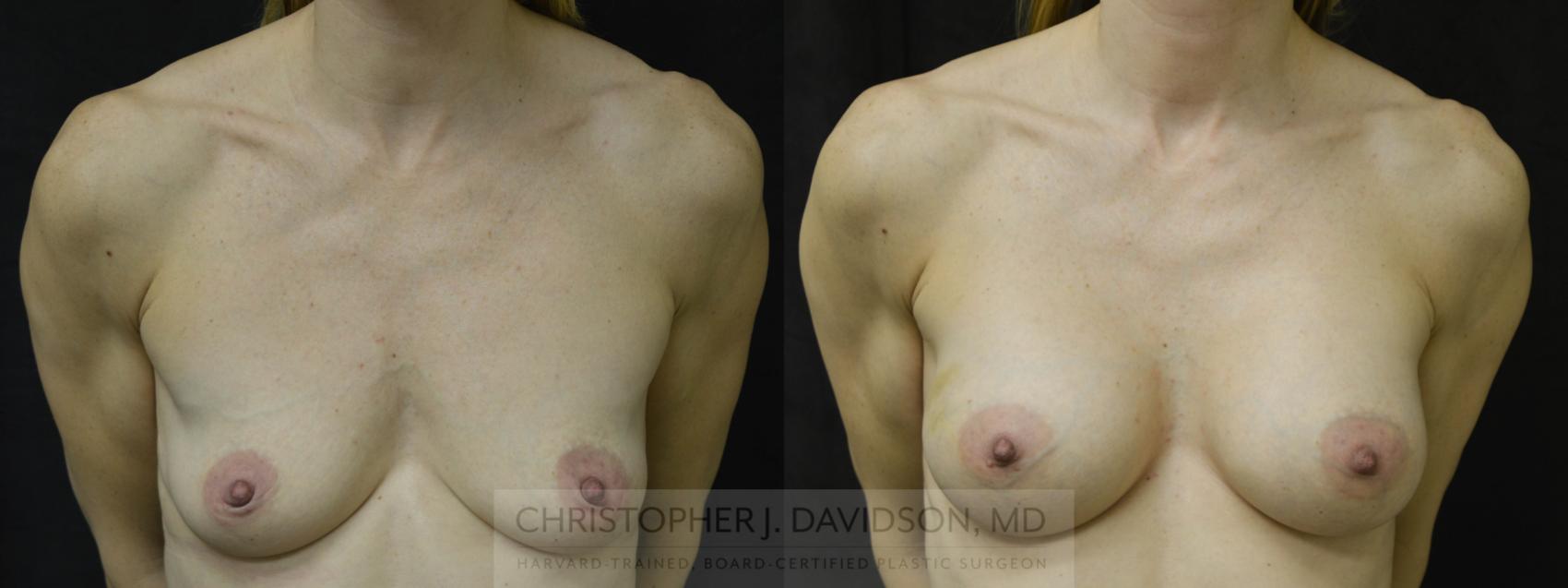 Breast Augmentation Case 33 Before & After View #1 | Wellesley, MA | Christopher J. Davidson, MD