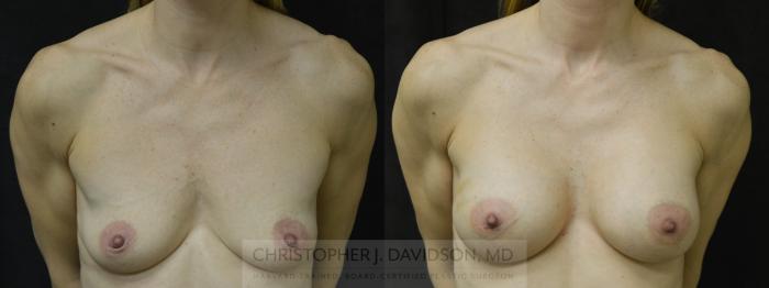 Breast Augmentation Case 33 Before & After View #1 | Boston, MA | Christopher J. Davidson, MD