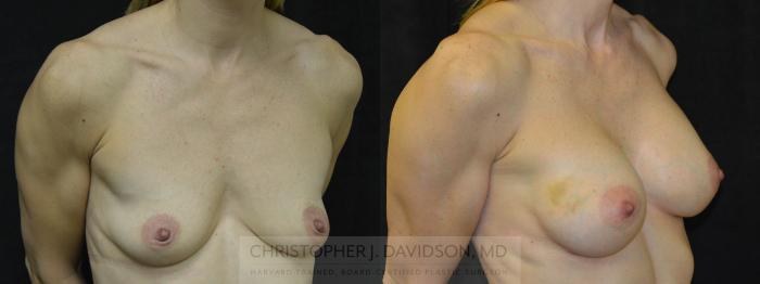 Breast Augmentation Case 33 Before & After View #2 | Boston, MA | Christopher J. Davidson, MD