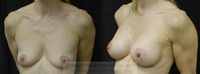 Breast Augmentation Case 33 Before & After View #3 | Boston, MA | Christopher J. Davidson, MD