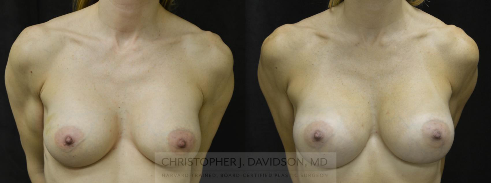 Breast Augmentation Case 34 Before & After View #1 | Boston, MA | Christopher J. Davidson, MD