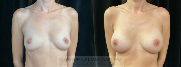 Breast Augmentation Case 355 Before & After Front | Boston, MA | Christopher J. Davidson, MD