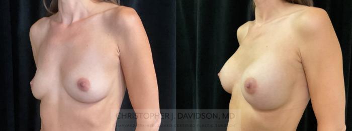 Breast Augmentation Case 355 Before & After Left Oblique | Boston, MA | Christopher J. Davidson, MD