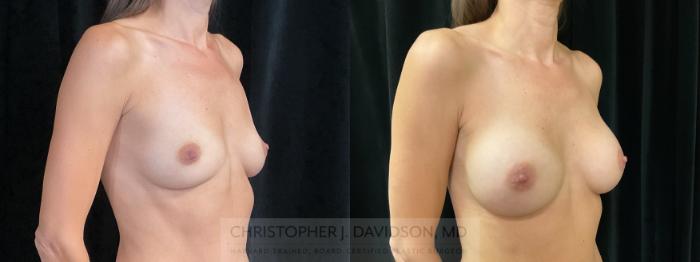 Breast Augmentation Case 355 Before & After Right Oblique | Boston, MA | Christopher J. Davidson, MD