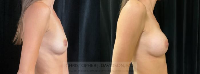 Breast Augmentation Case 355 Before & After Right Side | Boston, MA | Christopher J. Davidson, MD