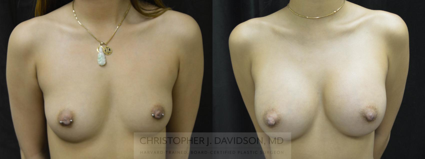 Breast Augmentation Case 36 Before & After View #1 | Wellesley & Boston, MA | Christopher J. Davidson, MD