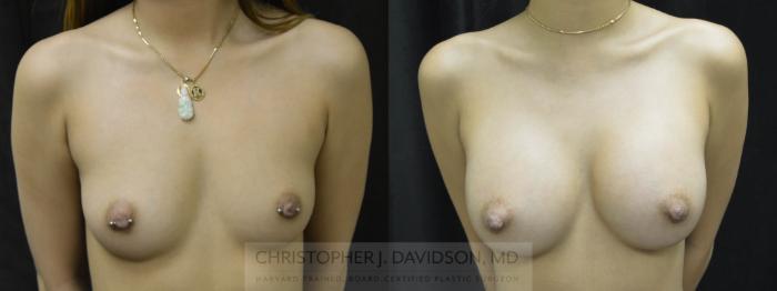 Breast Augmentation Case 36 Before & After View #1 | Wellesley, MA | Christopher J. Davidson, MD