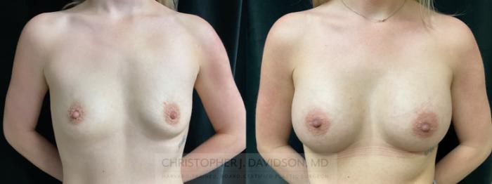 Breast Augmentation Case 364 Before & After Front | Boston, MA | Christopher J. Davidson, MD