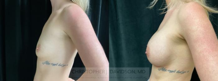 Breast Augmentation Case 364 Before & After Left Side | Boston, MA | Christopher J. Davidson, MD