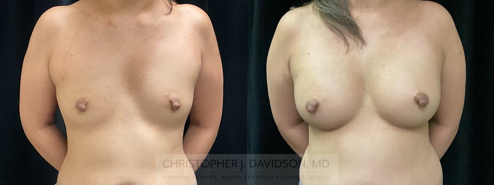 Breast Augmentation Case 368 Before & After Front | Boston, MA | Christopher J. Davidson, MD