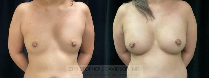 Breast Augmentation Case 368 Before & After Front | Boston, MA | Christopher J. Davidson, MD