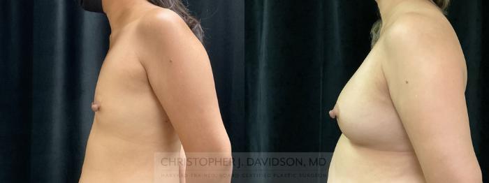 Breast Augmentation Case 368 Before & After Left Side | Boston, MA | Christopher J. Davidson, MD