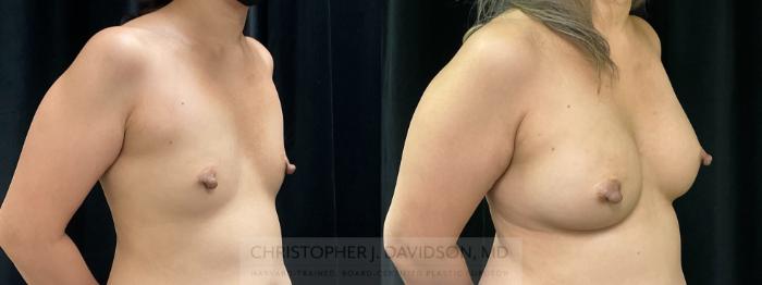 Breast Augmentation Case 368 Before & After Right Oblique | Boston, MA | Christopher J. Davidson, MD