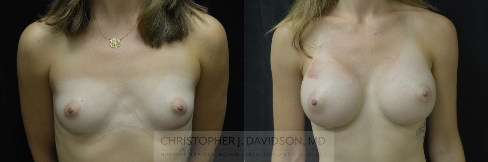 Breast Augmentation Case 37 Before & After View #1 | Boston, MA | Christopher J. Davidson, MD