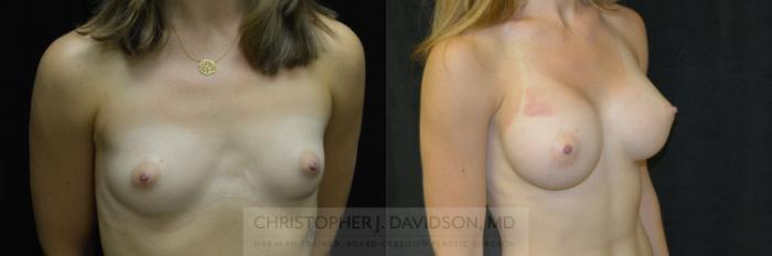 Breast Augmentation Case 37 Before & After View #2 | Boston, MA | Christopher J. Davidson, MD