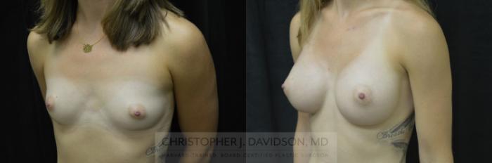 Breast Augmentation Case 37 Before & After View #3 | Boston, MA | Christopher J. Davidson, MD