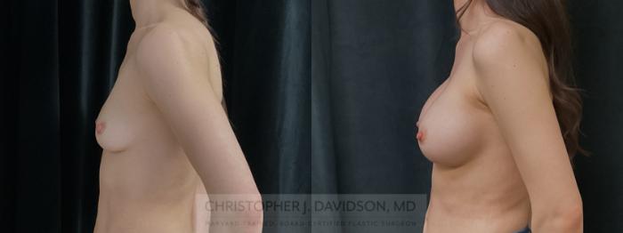 Breast Augmentation Case 372 Before & After Left Side | Boston, MA | Christopher J. Davidson, MD