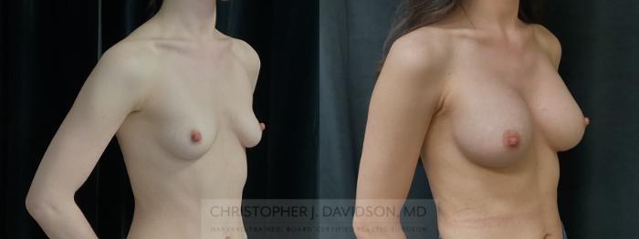 Breast Augmentation Case 372 Before & After Right Oblique | Boston, MA | Christopher J. Davidson, MD