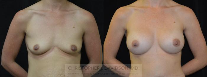 Breast Augmentation Case 377 Before & After Front | Boston, MA | Christopher J. Davidson, MD