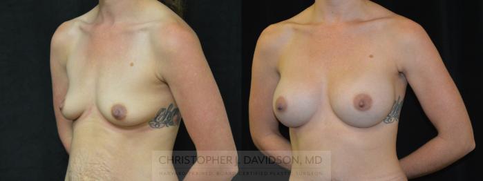 Mommy Makeover Case 377 Before & After Left Oblique | Boston, MA | Christopher J. Davidson, MD