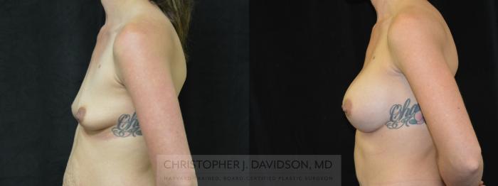 Mommy Makeover Case 377 Before & After Left Side | Boston, MA | Christopher J. Davidson, MD