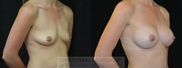 Breast Augmentation Case 377 Before & After Right Oblique | Boston, MA | Christopher J. Davidson, MD