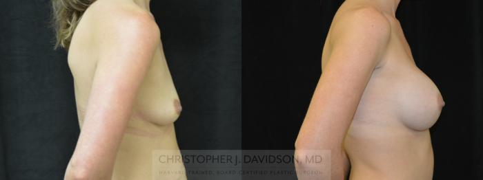 Mommy Makeover Case 377 Before & After Right Side | Boston, MA | Christopher J. Davidson, MD