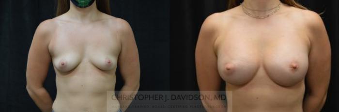 Breast Augmentation Case 378 Before & After Front | Boston, MA | Christopher J. Davidson, MD