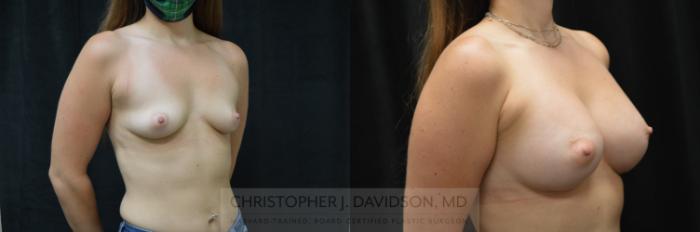 Breast Augmentation Case 378 Before & After Left Side | Boston, MA | Christopher J. Davidson, MD