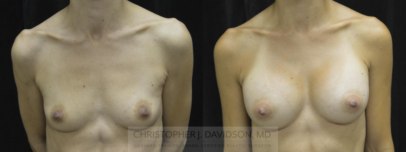 Breast Augmentation Case 38 Before & After View #1 | Boston, MA | Christopher J. Davidson, MD