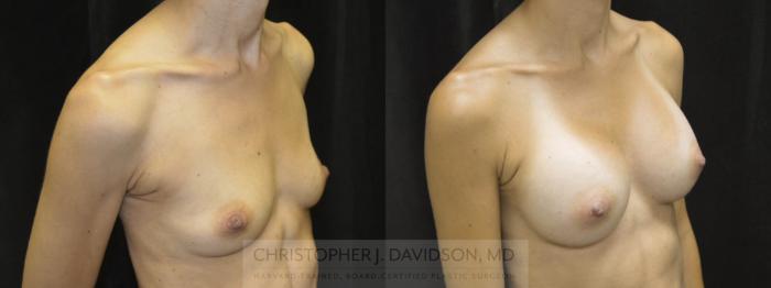 Breast Augmentation Case 38 Before & After View #2 | Boston, MA | Christopher J. Davidson, MD
