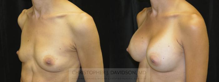 Breast Augmentation Case 38 Before & After View #3 | Boston, MA | Christopher J. Davidson, MD