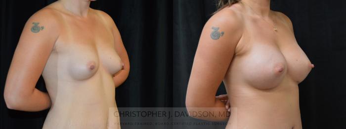 Breast Augmentation Case 380 Before & After Right Oblique | Boston, MA | Christopher J. Davidson, MD