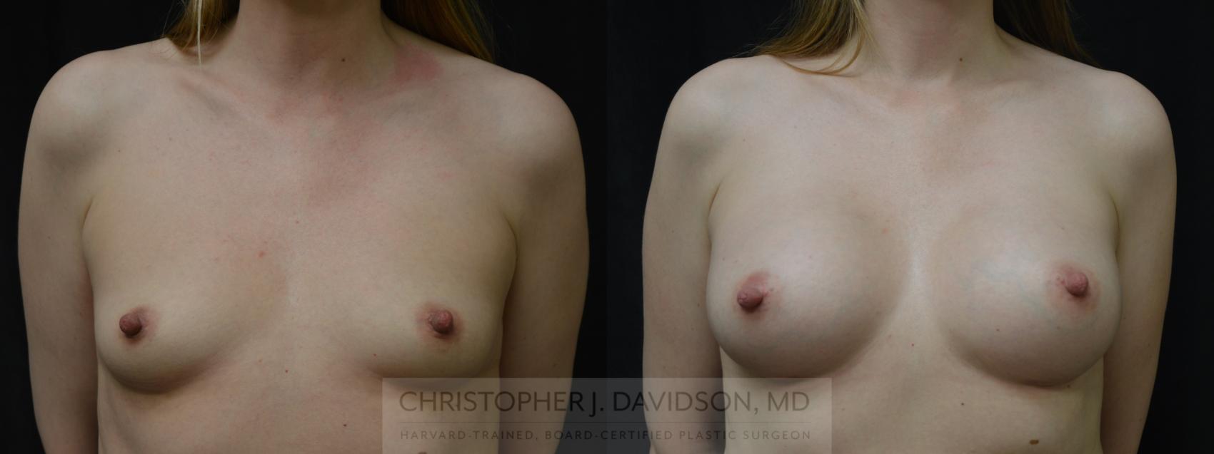 Breast Augmentation Case 381 Before & After Front | Boston, MA | Christopher J. Davidson, MD