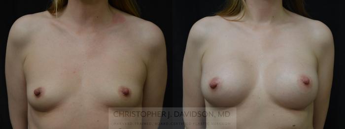 Breast Augmentation Case 381 Before & After Front | Boston, MA | Christopher J. Davidson, MD