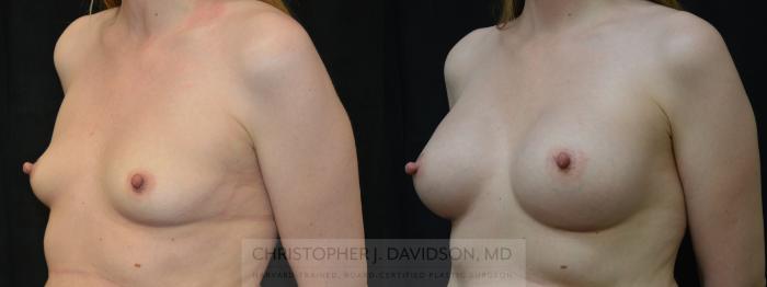 Breast Augmentation Case 381 Before & After Left Oblique | Boston, MA | Christopher J. Davidson, MD