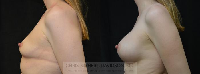 Breast Augmentation Case 381 Before & After Left Side | Boston, MA | Christopher J. Davidson, MD