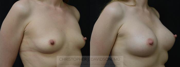 Breast Augmentation Case 381 Before & After Right Oblique | Boston, MA | Christopher J. Davidson, MD