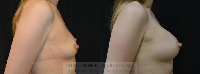 Breast Augmentation Case 381 Before & After Right Side | Boston, MA | Christopher J. Davidson, MD