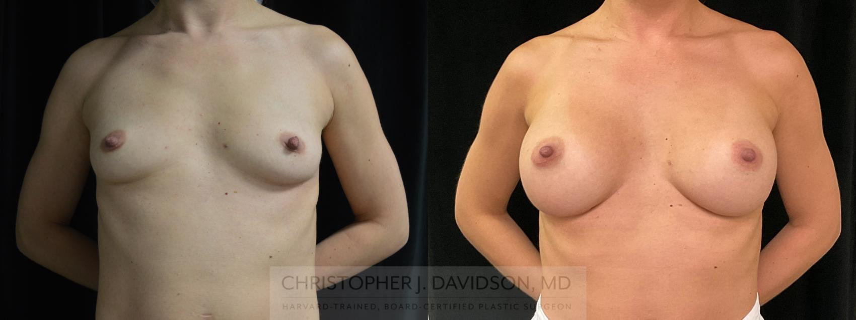 Breast Augmentation Case 383 Before & After Front | Boston, MA | Christopher J. Davidson, MD