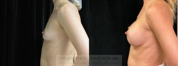 Breast Augmentation Case 383 Before & After Left Side | Boston, MA | Christopher J. Davidson, MD