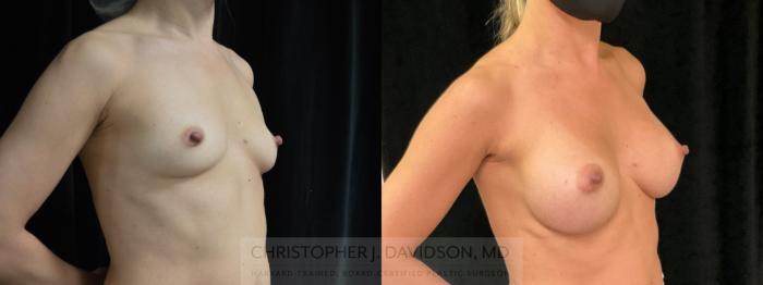 Breast Augmentation Case 383 Before & After Right Oblique | Boston, MA | Christopher J. Davidson, MD