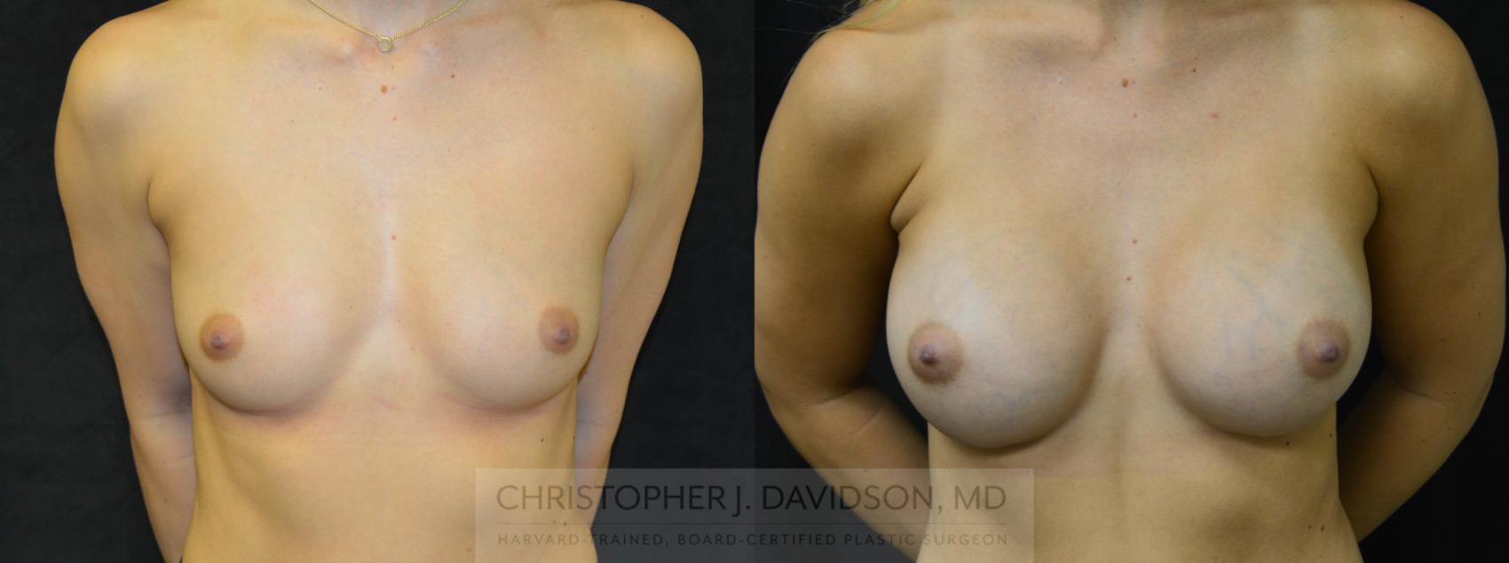 Breast Augmentation Case 39 Before & After View #1 | Wellesley, MA | Christopher J. Davidson, MD