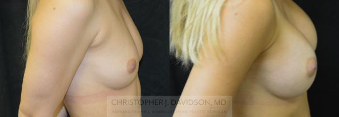 Breast Augmentation Case 39 Before & After View #2 | Boston, MA | Christopher J. Davidson, MD
